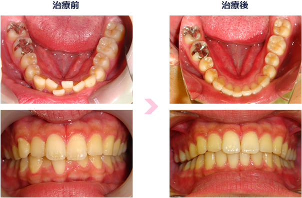 インビザラインの治療例