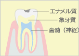 軽度の虫歯(C1)