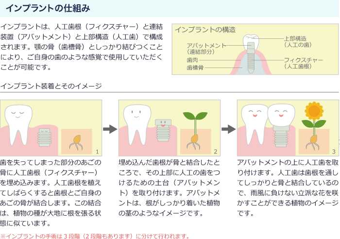 インプラントの仕組み